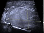 Sonographie – Kaposiformes Hämangioendotheliom