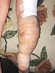 Klippel-Trénaunay-Syndrom, Lymphorrhoe am Bein