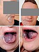 Venöse Malformation – Mund- Rachenraum – nach Therapie