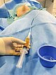 Sklerosierungstherapie der lymphatischen Malformation