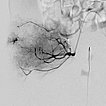 DSA – Kaposiformes Hämangioendotheliom