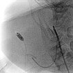 Digitale Subtraktionsangiographie – Infantiles Hämangiom