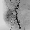 Digitale Subtraktionsangiographie – Infantiles Hämangiom