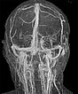 MR-Angiographie – venöse Malformation