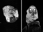 MRT – Lymphatische Malformation Gesicht