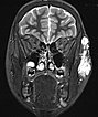 MRT – venöse Malformation an Wange