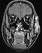 MRT – venöse Malformation an Wange