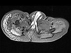 MRT – Kaposiformes Hämangioendotheliom