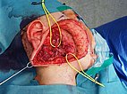 Operation – Lymphatische Malformation der Parotis