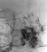 Röntgenbild – Venöse Malformation an Wange
