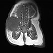 MRT – Kaposiformes Hämangioendotheliom