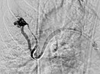 Digitale Subtraktionsangiographie – pulmonale AVM 