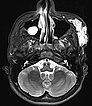 MRT – venöse Malformation an Wange