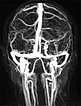 MR-Angiographie – venöse Malformation