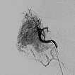 Digitale Subtraktionsangiographie – Infantiles Hämangiom