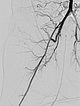 MR-Angiographie – Kaposiformes Hämangioendotheliom