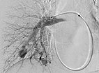 Digitale Subtraktionsangiographie – pulmonale AVM 