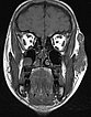 MRT – venöse Malformation an Wange