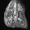 MRT – Kaposiformes Hämangioendotheliom