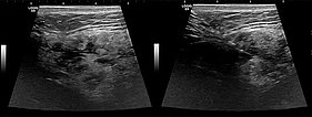 Sonographie – Venöse Malformation – Mund- Rachenraum