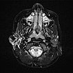 MRT nach Operation – Lymphatische Malformation der Parotis