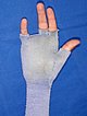 Arteriovenöse Malformation an Hand – Kompressionshandschuh