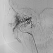 Digitale Subtraktionsangiographie – Infantiles Hämangiom