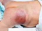 Kaposiformes Hämangioendotheliom bei Säugling