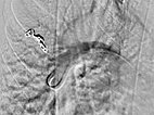 Digitale Subtraktionsangiographie – pulmonale AVM 