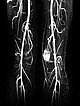 MR-Angiographie – Venöse Malformation