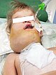 Endotrachealtubus
