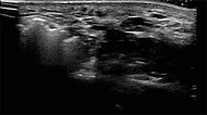 Sonographie während Sklerosierungsbehandlung