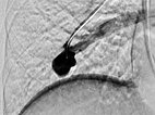 Digitale Subtraktionsangiographie – pulmonale AVM 