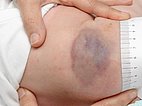Kaposiformes Hämangioendotheliom nach Therapie