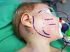 Operation – Lymphatische Malformation der Parotis