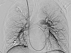 Digitale Subtraktionsangiographie – pulmonale AVM 