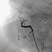 Digitale Subtraktionsangiographie – Infantiles Hämangiom