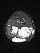 MRT – Fibro Adipose Vascular Anomaly an Wade