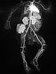 MR-Angiographie – Kaposiformes Hämangioendotheliom