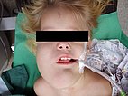 Lymphatische Malformation Gesicht – vor erneuter Operation