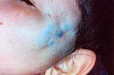 9-jähriger Junge mit weicher, bläulicher Schwellung