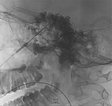 Sklerosierungstherapie – Venöse Malformation an Wange