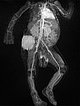 MR-Angiographie – Kaposiformes Hämangioendotheliom