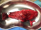 Resektat – Fibro Adipose Vascular Anomaly an Wade
