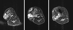 MRT – Lymphatische Malformation an Gesicht und Hals