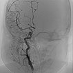 Digitale Subtraktionsangiographie – Infantiles Hämangiom