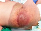 Kaposiformes Hämangioendotheliom bei Säugling