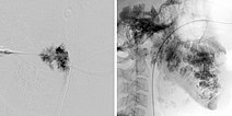 Sklerosierung – Venöse Malformation – Mund- Rachenraum