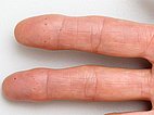 Osler Spots an Finger