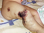 Klippel-Trénaunay-Syndrom, Lymphorrhoe am Bein